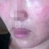 女性朋友怎样的预防春季皮肤过敏