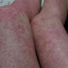 皮肤过敏患者不能吃海鲜的几大原因