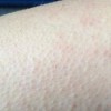 临床上皮肤过敏主要有以下几种辨别原因