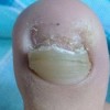 明了甲沟炎该怎样的预防