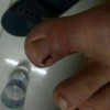 哪些措施可以帮助治疗甲沟炎呢