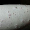疥疮的临床症状剖析