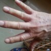 疥疮的临床症状