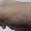 疥疮的症状我们一定要明白