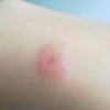 疥疮的治疗的措施