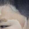 牛奶咖啡斑的图片