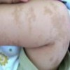 咖啡斑的诱发病因有什么