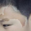 脸上长咖啡斑的原因是什么