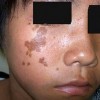 牛奶咖啡斑的治疗费用是多少