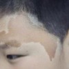 对于咖啡斑治疗患者存在的错误认识