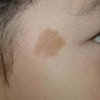 哪些人不适合用激光治疗咖啡斑