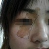 咖啡斑治疗的依据及效果分析