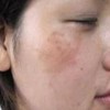 慢性咖啡斑如何治疗好