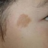 咖啡斑的激光治疗详解及原则介绍
