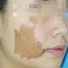 咖啡斑的治疗办法有什么