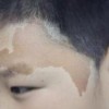 咖啡斑在治疗后要注意什么