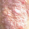 秋季银屑病高发的病因有什么