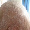男性银屑病发病的病因有什么