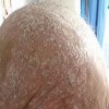 女性银屑病病因有什么