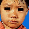 正确预防传染性软疣