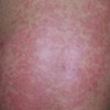 皮肤瘙痒与疥疮的区别是什么呢