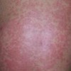 老年人预防皮肤瘙痒症的措施