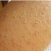 皮肤瘙痒期疙瘩的原因是什么