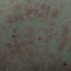 皮肤瘙痒的原因与治疗