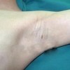 了解腋臭原因做好预防为自己健康负责