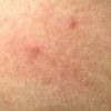 秋冬季怎样预防瘙痒症
