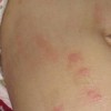 冬季瘙痒症的病因和症状