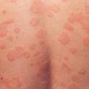 瘙痒症的典型症状