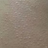 瘙痒症的表现分类