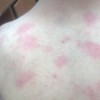 脸上常常瘙痒要怎么做