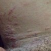 老年瘙痒症的治疗办法