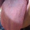慢性艾滋病治疗