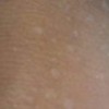 女性患上花斑癣的病因有什么