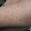 花斑癣是怎么来的