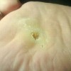 鸡眼行不行传染的能力