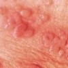 生殖器疱疹的危害都包含什么呢