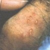 男性生殖器疱疹的症状特征