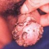 男性生殖器疱疹的症状