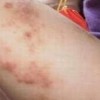 皮炎湿疹荨麻疹的五怕