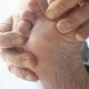 手足癣患者在治疗的进程中如何做好保养作业