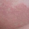 引发股癣皮肤病的病菌有哪些