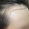 脱发治疗什么最有效