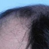 女性更年期怎样的预防脱发