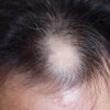 脱发必要如何治疗