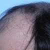 脱发的治疗方法有哪些