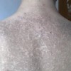 毛囊性鱼鳞病症状体现有啥